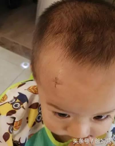 2岁宝宝摔跤手指破皮出血,小孩子摔跤出血去医院缝针