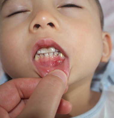 手足口病会传染成疱疹性咽峡炎吗,得了手足口还得疱疹性咽峡炎吗