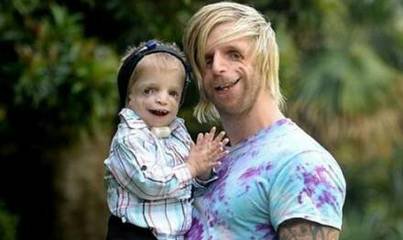 婴儿鬼脸综合症症状图,1岁4个月鬼脸综合症能治好吗