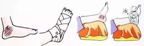 打球崴脚了怎么快速处理,打球崴脚了的正确处理流程