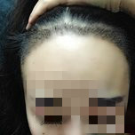 大额头适合用什么植发,大额头发际线高怎么办