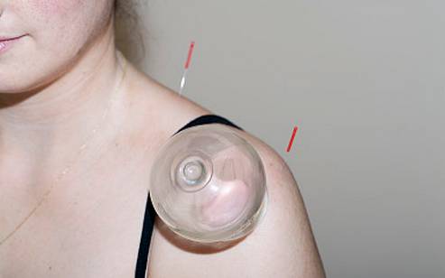 拔罐后不同位置罐印颜色不同,拔罐出现罐斑的原理