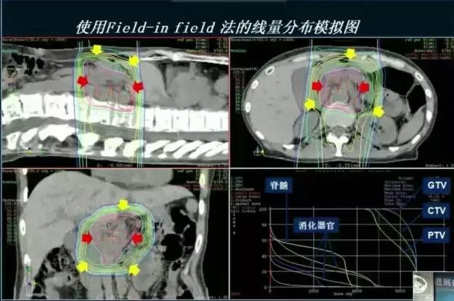 「专访」日本指宿质子中心荻野尚院长：200例胰腺癌患者经验