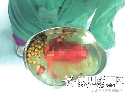 贵州：吃蛋液包肉老太痛得受不了医生：胆囊肿如青芒已切除