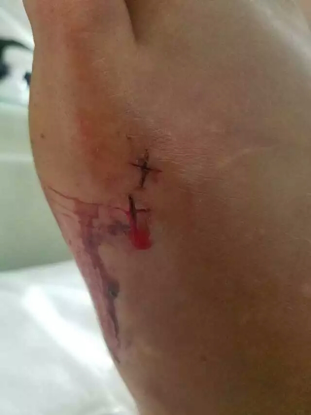 蛇毒急救,中蛇毒正确急救方法是什么