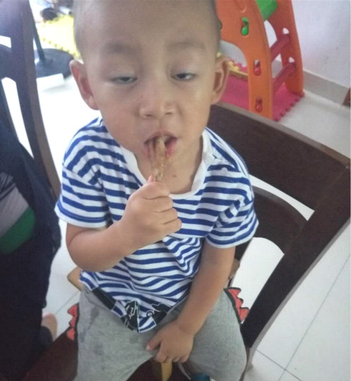 手足口病会传染成疱疹性咽峡炎吗,得了手足口还得疱疹性咽峡炎吗