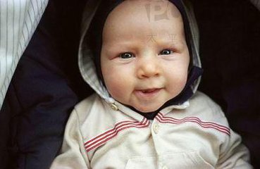 婴儿鬼脸综合症症状图,1岁4个月鬼脸综合症能治好吗