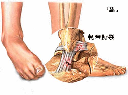 打球崴脚了怎么快速处理,打球崴脚了的正确处理流程