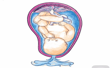 胎膜早破是什么症状,胎膜早破是什么引起的