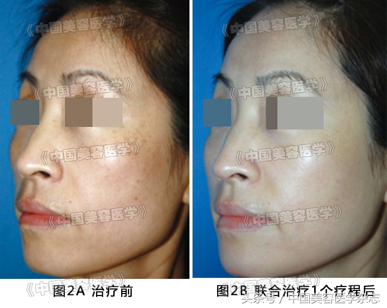 干货：治疗*褐斑黄**的神药，真的这么神奇，连美白针也有它的成份！