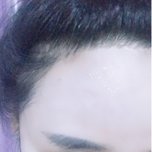 大额头适合用什么植发,大额头发际线高怎么办