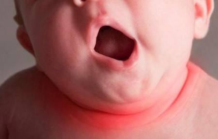 防止宝宝脖子被淹擦什么,宝宝脖子被淹为什么要用茶水洗