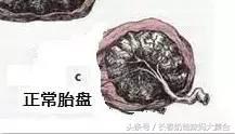 帆状胎盘能正常活动吗,帆状胎盘在胎膜上