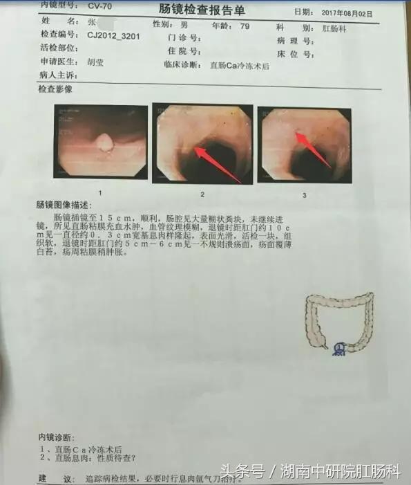 低位直肠癌冷冻治疗,直肠癌冷冻