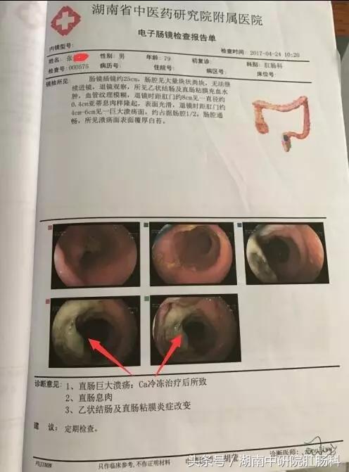 低位直肠癌冷冻治疗,直肠癌冷冻