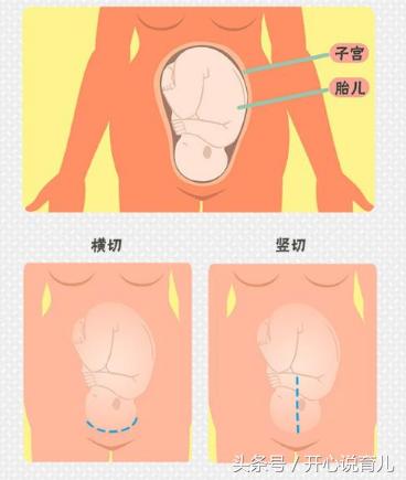 女人一生最多能剖几次产,一胎剖宫产的二胎要不要提前剖