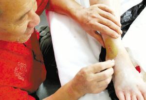 蛇毒急救,中蛇毒正确急救方法是什么