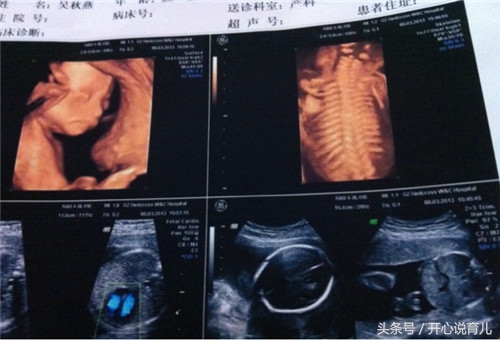 孕妇四维彩超跟大排畸有什么区别,孕期四维大排畸几周做最合适