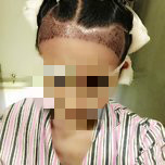 大额头适合用什么植发,大额头发际线高怎么办