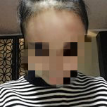 大额头适合用什么植发,大额头发际线高怎么办