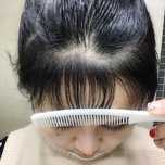 大额头适合用什么植发,大额头发际线高怎么办