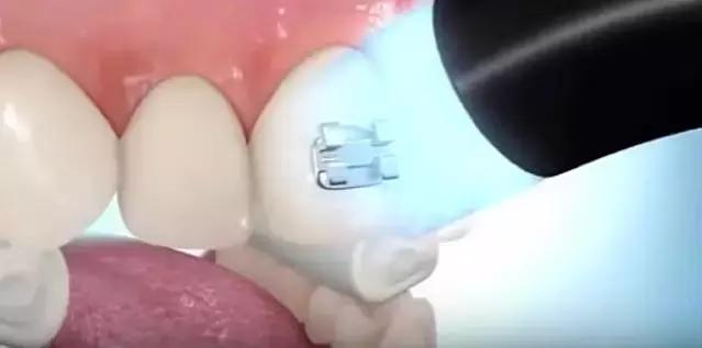 箍牙的牙套是怎么固定上去的,箍牙齿全过程图片