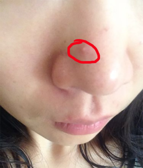 鼻子上挤出来的白色东西怎么去除,鼻子上会挤出白色的东西怎么改善