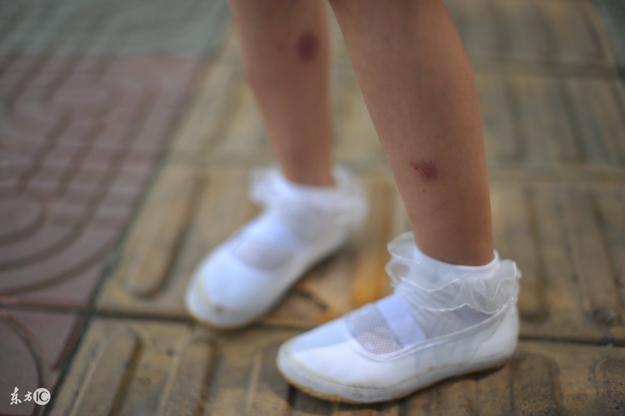 蚊虫叮咬导致的过敏性皮炎,蚊虫叮咬引起的皮炎喝什么药