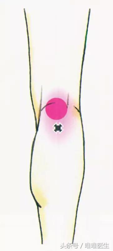 绝对干货膝盖损伤知识一网打尽,膝关节疼痛知识科普