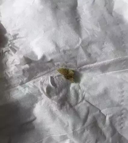 多发性双肾结石良方,多发性胆囊结石中医