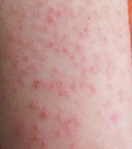 身上还痒得了荨麻疹怎么办,荨麻疹痒痒怎么缓解