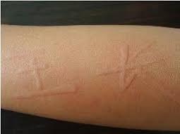 身上还痒得了荨麻疹怎么办,荨麻疹痒痒怎么缓解