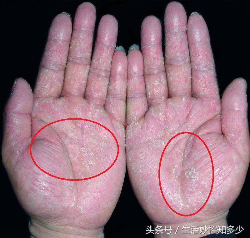 手脚脱皮有什么特效药吗,手脚脱皮怎么不用药