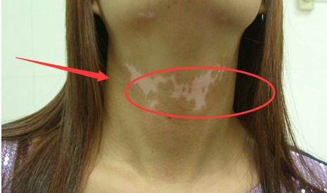 白癜风病人的问题,白癜风总有新的白斑出现怎么办