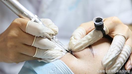 纹唇后的晕色期是什么意思,眉眼凹陷怎么修复