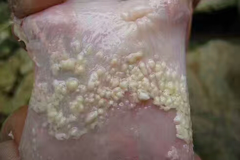 鸡白色念珠菌用什么药,白色念珠菌是什么原因形成的