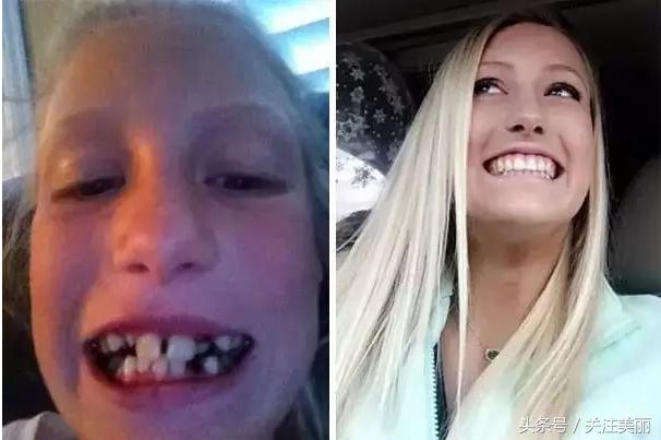 戴了牙套后嘴唇会变薄吗,戴牙套后会导致嘴变凸吗