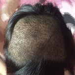 大额头适合用什么植发,大额头发际线高怎么办