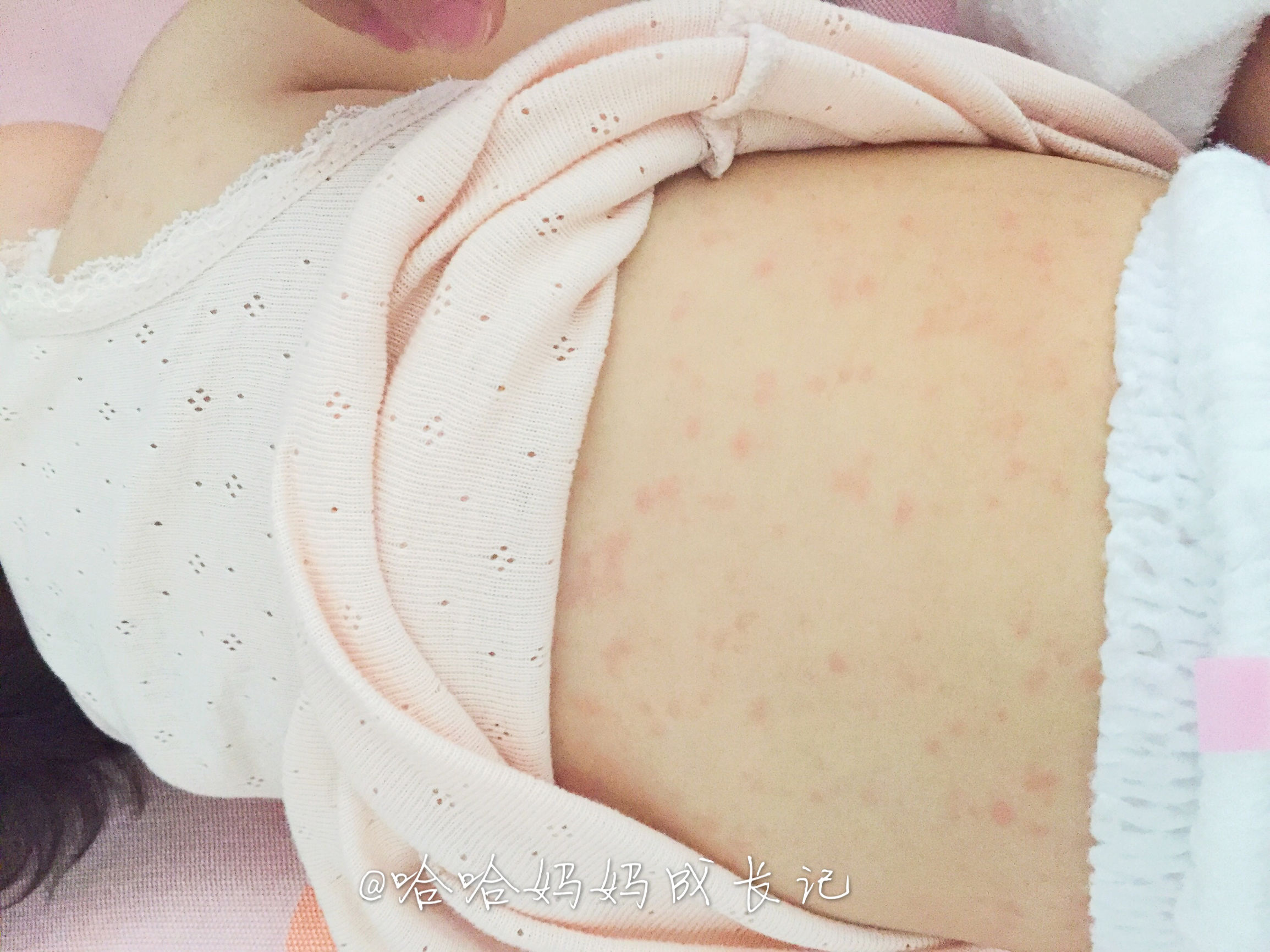 幼儿急疹真实经历,幼儿急疹没那么可怕