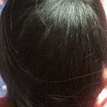 大额头适合用什么植发,大额头发际线高怎么办