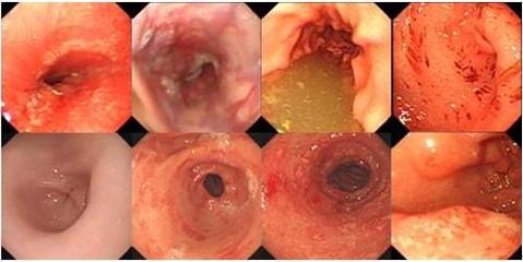 保护胃粘膜根除幽门螺旋杆菌 (怎么杀幽门螺旋杆菌治胃病)