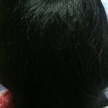 大额头适合用什么植发,大额头发际线高怎么办