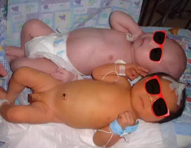 深圳儿童黄疸日间光疗,深圳黄疸光疗