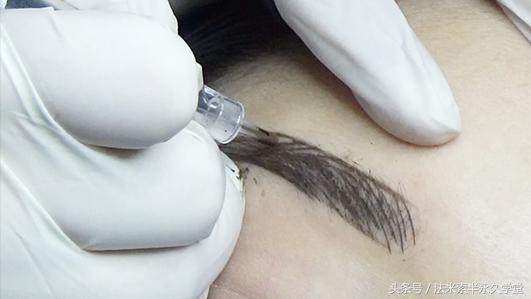 纹唇后的晕色期是什么意思,眉眼凹陷怎么修复