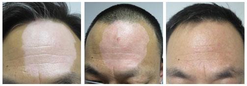 科普什么是顽固性白癜风,科普白癜风是怎么回事