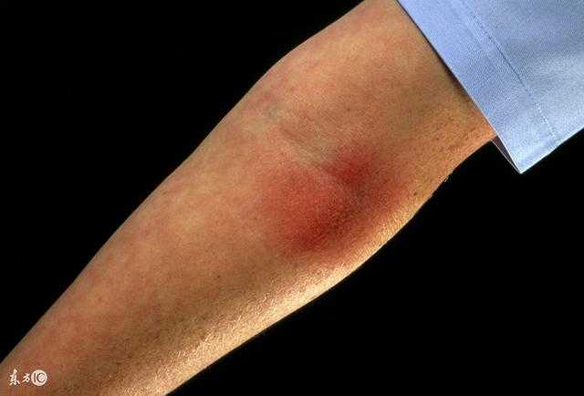 过敏性皮炎很难缠中医来帮你排忧解难