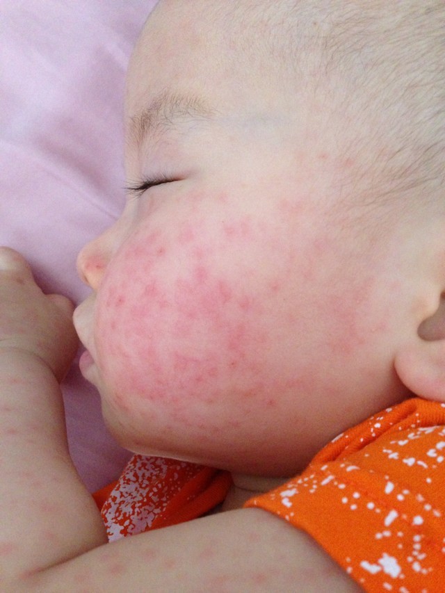 九个月宝宝出了一身疹子,9个月宝宝出些小红疹低烧