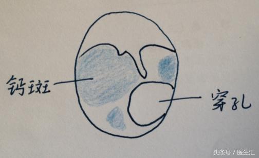 听力低频降落怎么恢复,低频听力降落耳鸣怎么治疗