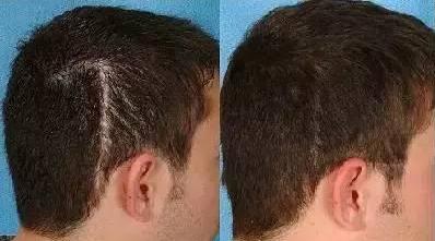 除了植发，就没有方法能拯救你头上的疤？有！