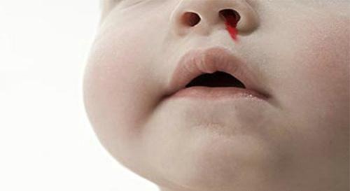 孩子鼻子痒一揉就流鼻血,8岁孩子流鼻血怎么回事